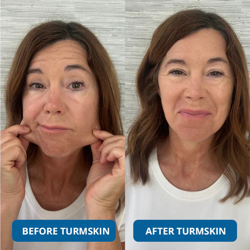 🏆LAST DAY BUY 1 GET 1 FREE⚡3% Hyaluronic Acid Ultra Hydrating Serum by TurmSkin
