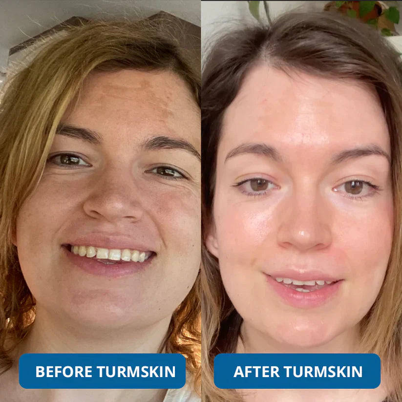 🏆LAST DAY BUY 1 GET 1 FREE⚡3% Hyaluronic Acid Ultra Hydrating Serum by TurmSkin