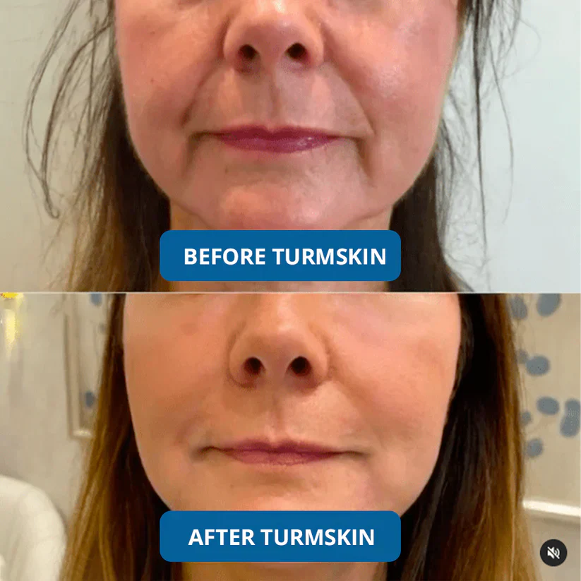 🏆LAST DAY BUY 1 GET 1 FREE⚡3% Hyaluronic Acid Ultra Hydrating Serum by TurmSkin